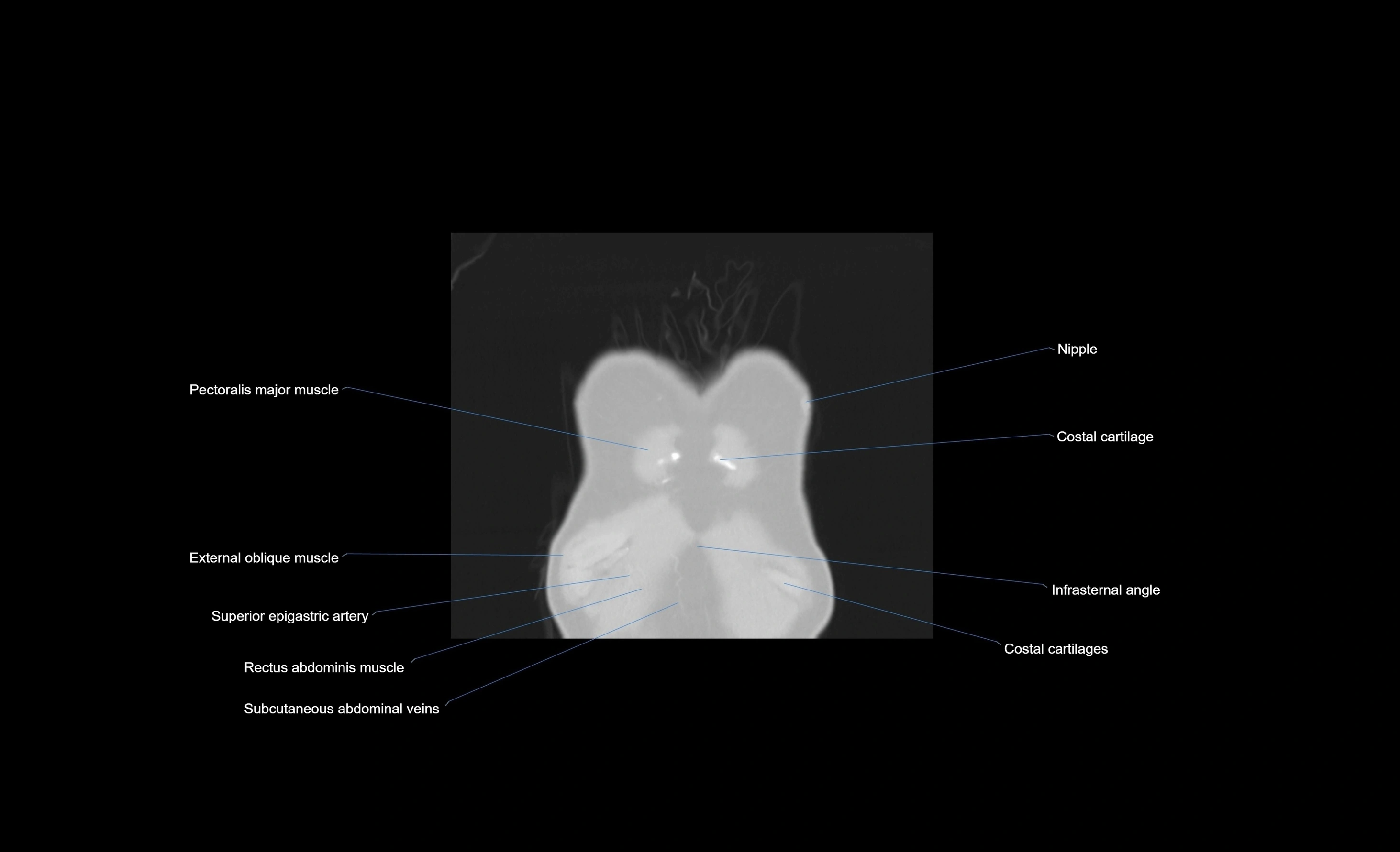 CT chest (thorax) labelled coronal cross sectional anatomy radiology image-00108.webp